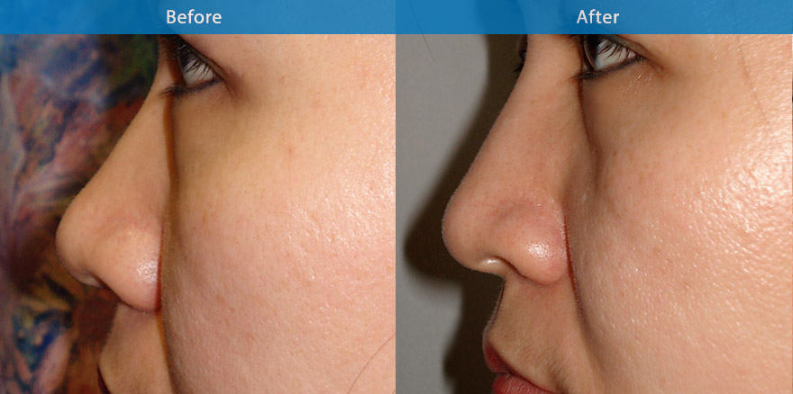 <h3>Case 5</h3><p>42 Asian female requested  nonsurgical improvement to her nose appearance. Dermal filler was placed in bridge of  the nose. The after photos showed the total transformation to her nose, with a better and higher  </p><p>Expected duration: ~ 15 months.</p>