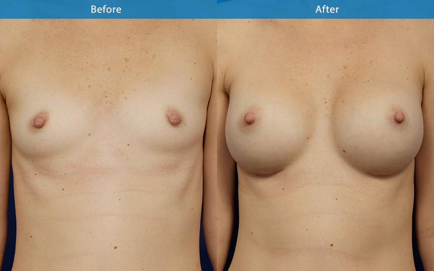 <h3>Case 1</h3><p><strong>Mummy make over </strong></p><p>This 37year old mother of requested breast enlargement to “ give her some boobs”, “gone” from pregnancies . She does not want big breasts. C cup breasts were created with round implant to provide some moderate fullness to the upper pole , improve the and overall flatness to the chest and a better breast shape.</p>