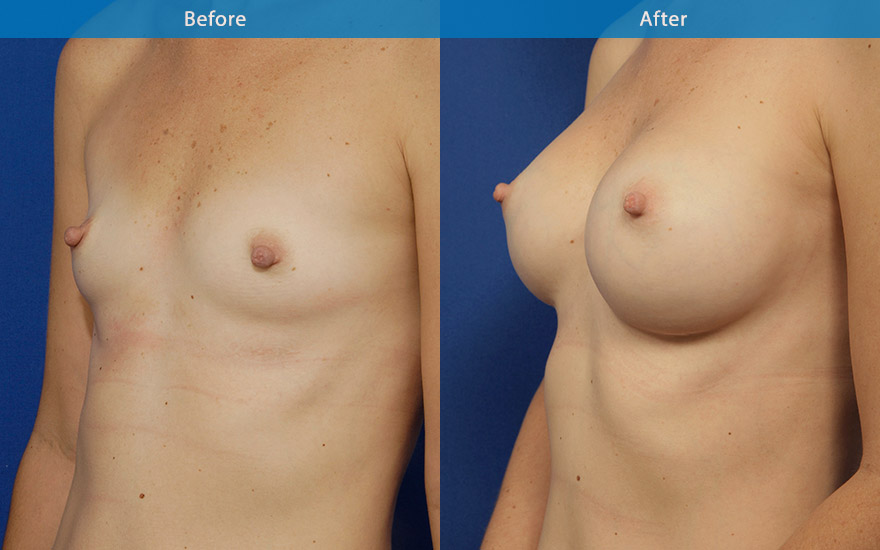 <h3>Case 1</h3><p><strong>Mummy make over </strong></p><p>This 37year old mother of requested breast enlargement to “ give her some boobs”, “gone” from pregnancies . She does not want big breasts. C cup breasts were created with round implant to provide some moderate fullness to the upper pole , improve the and overall flatness to the chest and a better breast shape.</p>