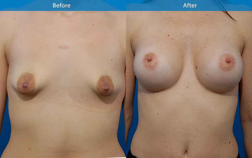 <h3>Case 10</h3><p>34 year old mum who has been extremely conscious of her breast appearance following the birth of her twins. She used to be D cup before babies and would like that to be restored. She requested a full breasts.</p><p><strong>Surgical plan</strong></p><p>High profile round implants were used to fill up the entire breast tissue and to provide the fullness as requested. The implants were placed carefully to rotate the downward pointing nipple to that of a more aesthetically optimal position.</p>
