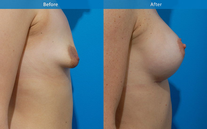 <h3>Case 10</h3><p>34 year old mum who has been extremely conscious of her breast appearance following the birth of her twins. She used to be D cup before babies and would like that to be restored. She requested a full breasts.</p><p><strong>Surgical plan</strong></p><p>High profile round implants were used to fill up the entire breast tissue and to provide the fullness as requested. The implants were placed carefully to rotate the downward pointing nipple to that of a more aesthetically optimal position.</p>