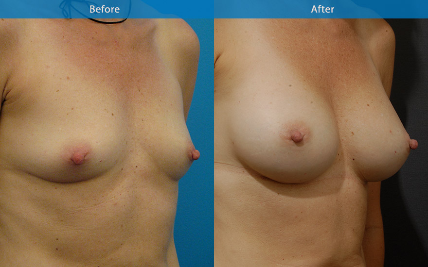 <h3>Case 11</h3><p>This 46 year old mother of two asked for an age appropriate breast enhancement. A large C cup tear drop shape breast was created to complement her body, age and personality.</p>