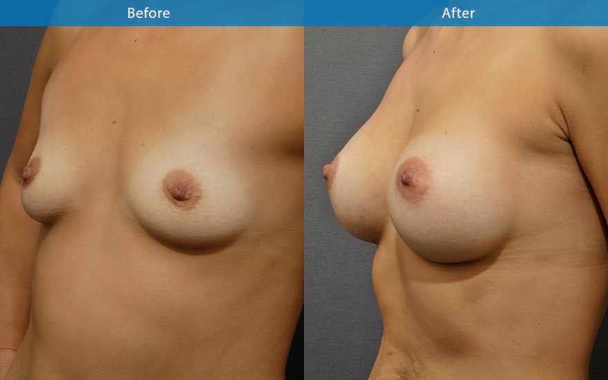 <h3>Case 13</h3><p>A moderate and proportionate enlargement from A to C cup with high profile round implant.</p><p align="center"><img src="/images/gallery/preg/13-1.jpg" /></p><p> </p>