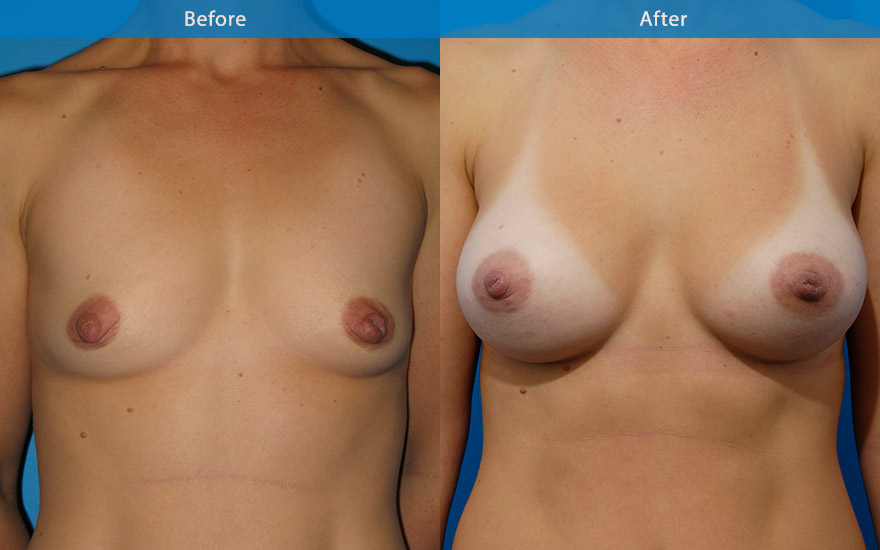 <h3>Case 2</h3><p>38 years old mum requested truly natural looking breasts. “Love to wear bikinis and must look natural in bikinis”</p><p>This lady has a long chest with empty and flat appearance in the upper part of chest. Tall tear drop implants were used to fill up the upper chest and creating a gentle slope from the chest to body of the breast and to the nipple creating a truly natural looking breasts. The conservative side breasts with the appropriate breast implants provide the feminising effect to the overall body appearance. She now enjoy her new bikinis even more!</p>