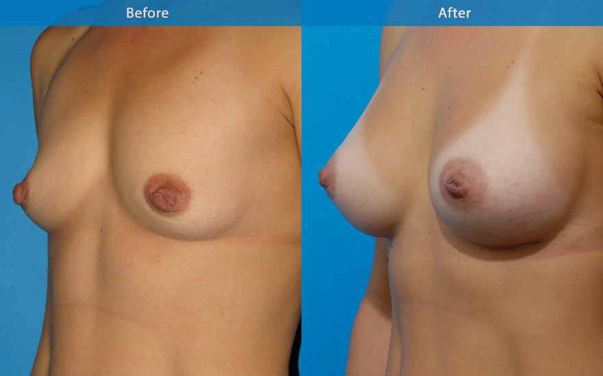 <h3>Case 2</h3><p>38 years old mum requested truly natural looking breasts. “Love to wear bikinis and must look natural in bikinis”</p><p>This lady has a long chest with empty and flat appearance in the upper part of chest. Tall tear drop implants were used to fill up the upper chest and creating a gentle slope from the chest to body of the breast and to the nipple creating a truly natural looking breasts. The conservative side breasts with the appropriate breast implants provide the feminising effect to the overall body appearance. She now enjoy her new bikinis even more!</p>