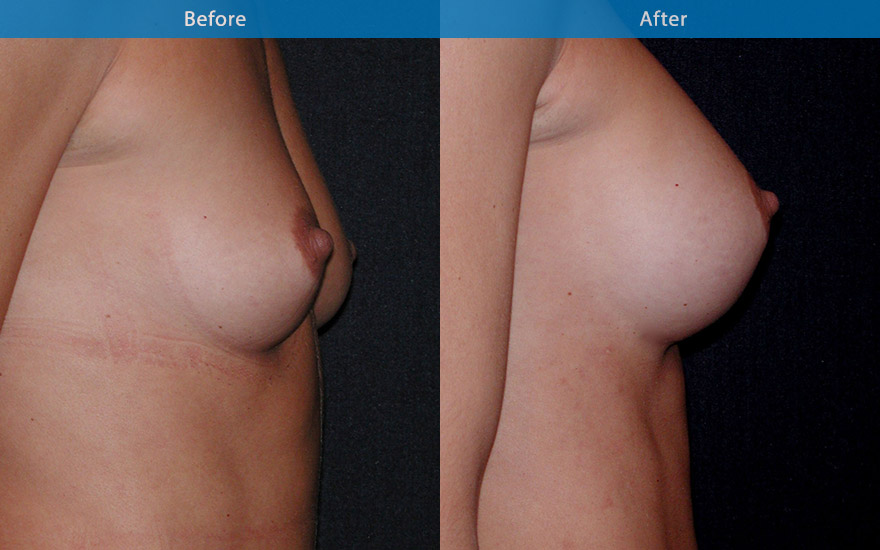 <h3>Case 3</h3><p><strong>Patient details:</strong></p><p>Aged 38, “I have a bony chest” “There is nothing on top” Like to increase her breast size from A to C cup to complement her tall frame. Like them to be “ very natural” and “ some cleavage will be nice”</p><p><strong>Surgical Plan</strong></p><p>This lady has a long, lean body and chest shape. To improve her “bony chest as well as enhancing her breast, a long and extraprojected tear drop shape implant were used in this case. Post surgically, demonstrating a well enhanced breast shape from A to C cup complementing her lean body frame and masking the underlying bony chest.. NB Round implant will not be optimal to meet the request.</p>