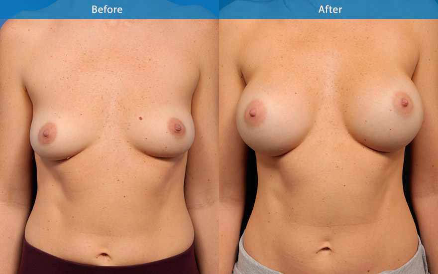 <h3>Case 4</h3><p><strong>Mummy make over</strong></p><p>This 38 year old mother of 2 requested breast enlargement to restore the upper pole breast fullness, loss from pregnancies . She does not want big breasts. D cup breasts were created with round implant to improve the width and fill the emptiness of her chest. The breasts fit her 178 cm tall frame.</p>