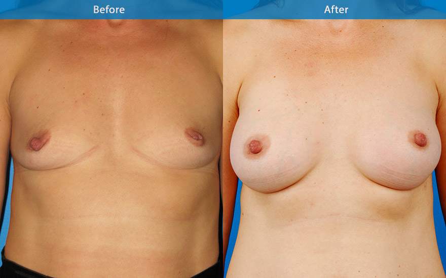 <h3>Case 5</h3><p>45 years old conservative mother of 2 decided to have some workover. Stage 1 : Like to have a conservative and totally natural looking breasts”</p><p>A very fit, athletic lady with a some what masculine body shape and minimal breast tissue. She will not tolerate any hints of “ implant look” C cup breasts were created with tear drop implant to provide a very natural looking breasts with some side boobs, creating a feminising outer breasts silhouette and a moderate fullness to the upper pole to improve the chest appearance</p>