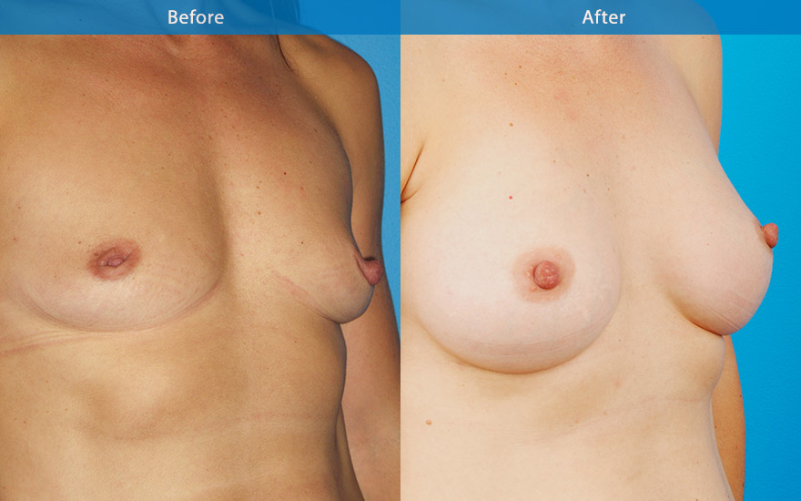 <h3>Case 5</h3><p>45 years old conservative mother of 2 decided to have some workover. Stage 1 : Like to have a conservative and totally natural looking breasts”</p><p>A very fit, athletic lady with a some what masculine body shape and minimal breast tissue. She will not tolerate any hints of “ implant look” C cup breasts were created with tear drop implant to provide a very natural looking breasts with some side boobs, creating a feminising outer breasts silhouette and a moderate fullness to the upper pole to improve the chest appearance</p>