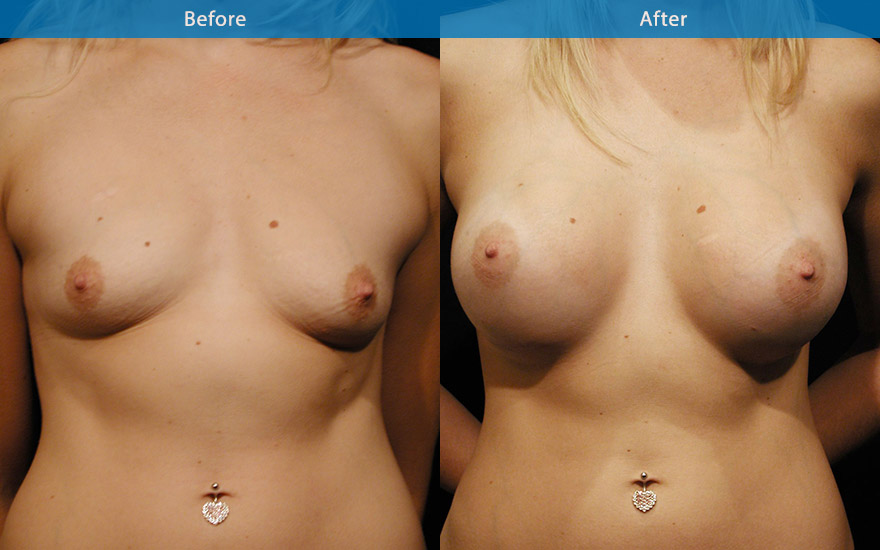 <h3>Case 6</h3><p>28 year old mother, a large proportionate enlargement with more fullness to the upper pole of the breasts. A 400gm high profile round implant placed under the muscle, to create a beautiful D cup breast as requested.</p>