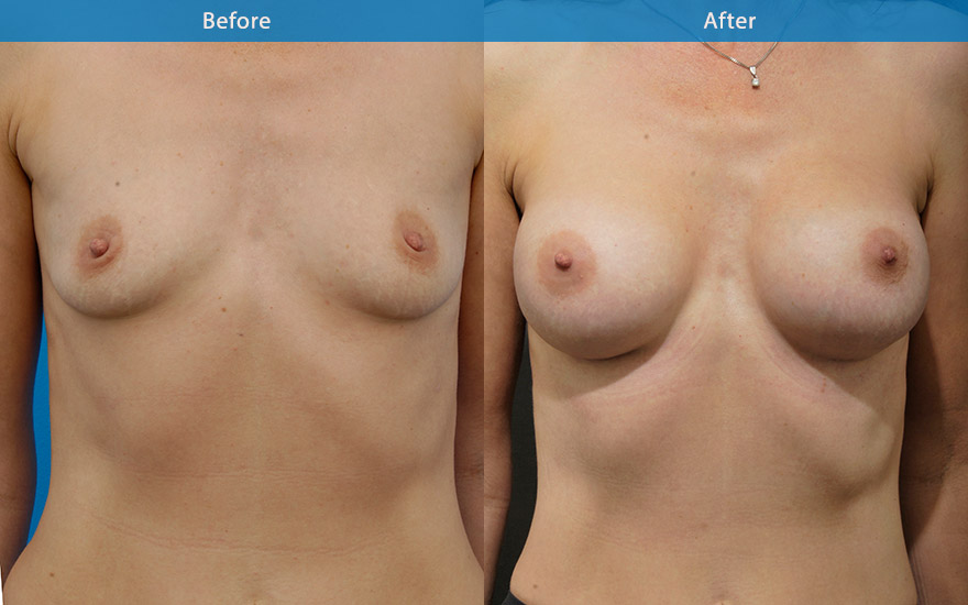 <h3>Case 7</h3><p>43 years old mother of four decided to “do something for myself”. “After 4 kids, I lost whatever little breast tissue I had “. “Please give me some boobs”.</p><p>A very fit , athletic lady with a some what masculine body shape. She does not want big breasts. C cup breasts were created with round implant to provide some side boobs, creating a feminising outer breasts silhouette, moderate fullness to the upper pole to improve the overall flatness to the chest and a better breast shape.</p>