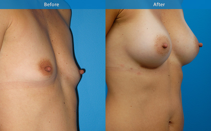 <h3>Case 8</h3><p>38year old mom, who enjoys jogging long distance. She requested conservative C cup to improve the breasts but must not interfere with her her running habits.</p><p>A very fit, athletic lady with a small petite frame with minimal breast tissue. Narrow and tall tear drop implants were used to provide breast fullness and a better breast shape to match her long lean frame, creating a feminising effect to her entire body with C cup breasts</p>