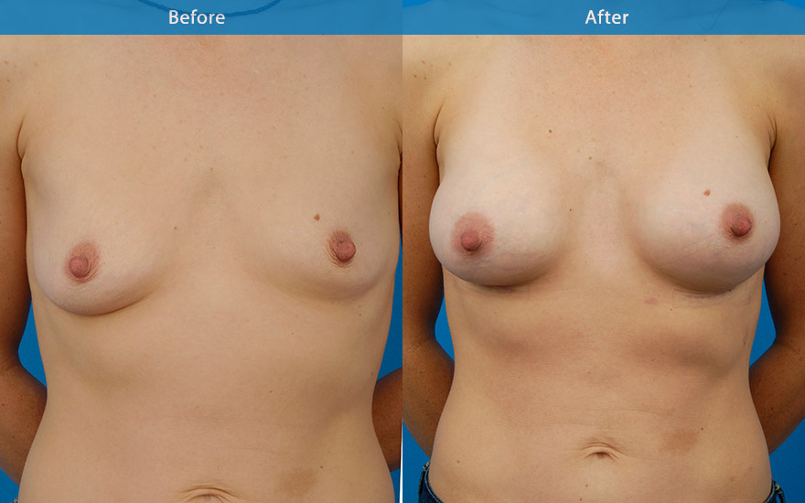 <h3>Case 9</h3><p>40 year old mother requested a conservative and “very natural looking “ breast enlargement to restore the loss breast fullness and the asymmetries . C cup shape breasts were created with tear drop shaped breast implants to improve the symmetries and restoring the upper pole fullness.</p>