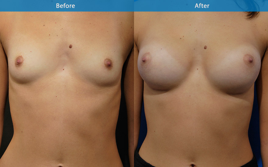 <h3>Case 1</h3><p>34F with a tall 177 cm and athletic frame requested a proportionate breast enlargement that suits her frame.</p><p>A suitable round breast implants were used to create a proportionate D cup breasts that balanced her body shape and frame.</p>