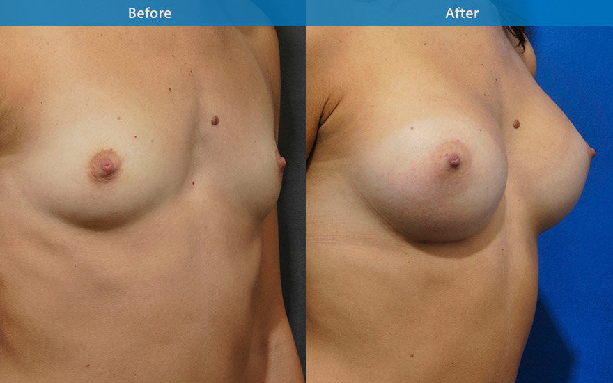 <h3>Case 1</h3><p>34F with a tall 177 cm and athletic frame requested a proportionate breast enlargement that suits her frame.</p><p>A suitable round breast implants were used to create a proportionate D cup breasts that balanced her body shape and frame.</p>