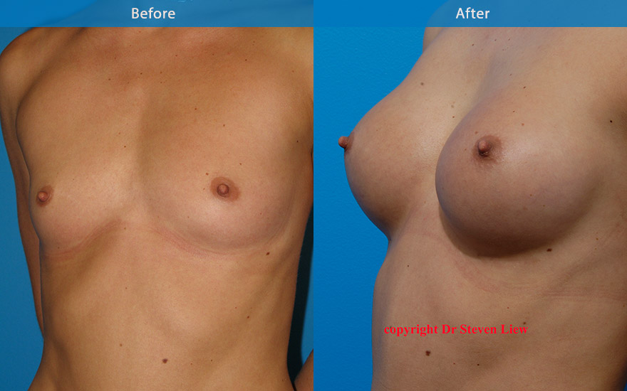 <h3>Case 2</h3><p>A small and proportionate enlargement from A to C cup with tear drop implant</p>