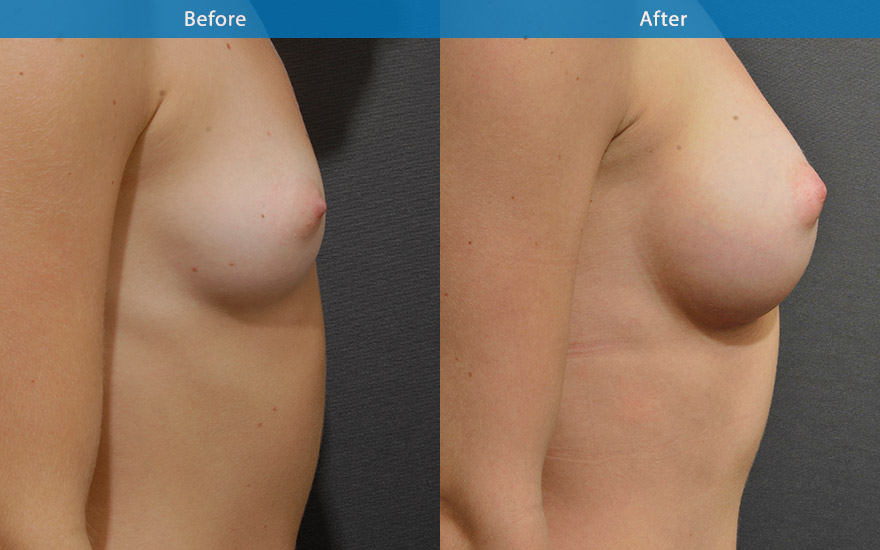 <h3>Case 3</h3><p><strong>Patient details:</strong></p><p>26 female requested a small and conservative breast enlargement that look as natural as possible to complement her acting career. Main requirement "looks so natural, minimal upper pole fullness so that the audience cannot tell in the big screen"</p><p><strong>Surgical Plan</strong></p><p>Soft round moderate profile implant were placed behind the muscle to create a fully natural looking large B cup breasts that look and feel soft. The end results looks completely natural with the viewers not able to notice the surgical implants.</p>