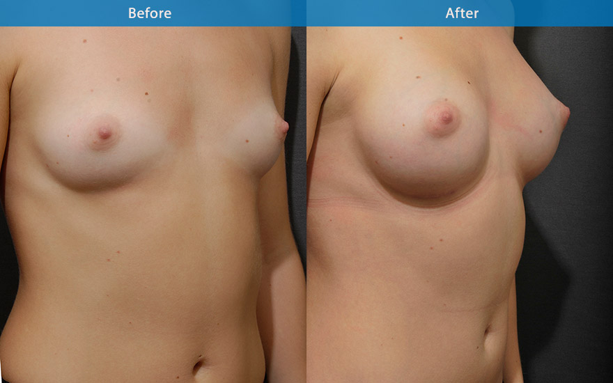 <h3>Case 3</h3><p><strong>Patient details:</strong></p><p>26 female requested a small and conservative breast enlargement that look as natural as possible to complement her acting career. Main requirement "looks so natural, minimal upper pole fullness so that the audience cannot tell in the big screen"</p><p><strong>Surgical Plan</strong></p><p>Soft round moderate profile implant were placed behind the muscle to create a fully natural looking large B cup breasts that look and feel soft. The end results looks completely natural with the viewers not able to notice the surgical implants.</p>
