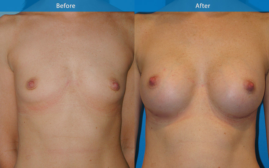 <h3>Case 4</h3><p><strong>Patient details:</strong></p><p>35 female with A cup breast, would like to have "just B cup please and very natural!" Surgical Plan</p><p><strong>Surgical Plan</strong></p><p>This lady has long boxy chest. She has AA Cup breast. A 270 gm teardrop implant was chosen to give her the look requested. The after photo shows the transformation following surgery, A to full B cup. In addition to the larger breast cup, the appearance of the chest and body has been improved from that of a boxy to that of a slimmer overall body appearance.</p>