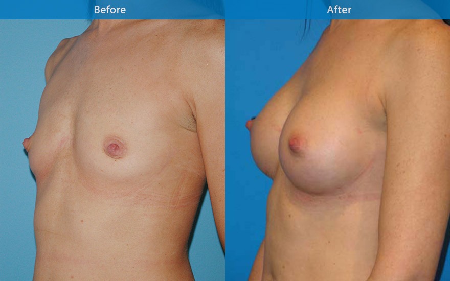 <h3>Case 4</h3><p><strong>Patient details:</strong></p><p>35 female with A cup breast, would like to have "just B cup please and very natural!" Surgical Plan</p><p><strong>Surgical Plan</strong></p><p>This lady has long boxy chest. She has AA Cup breast. A 270 gm teardrop implant was chosen to give her the look requested. The after photo shows the transformation following surgery, A to full B cup. In addition to the larger breast cup, the appearance of the chest and body has been improved from that of a boxy to that of a slimmer overall body appearance.</p>