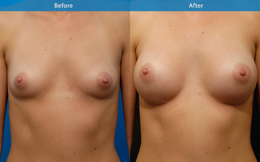 <h3>Case 5</h3><p><strong>Patient details:</strong></p><p>27 female requested a proportionate breast enlargement that look as natural as possible with moderate degree of upper pole fullness.</p><p>Preoperatively she has an existing good breast shape. The breasts were far apart. An appropriate sized set of round moderates profile implant was placed behind the muscle to create natural looking C cup breasts that look and feel completely natural. The cleavage has been improve to a more reasonable distance. The shape of her torso has also been enhanced with the gentle curve of the side breasts, creating a beautiful feminising silhouette.</p>
