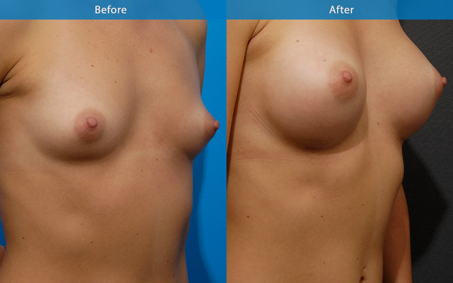 <h3>Case 5</h3><p><strong>Patient details:</strong></p><p>27 female requested a proportionate breast enlargement that look as natural as possible with moderate degree of upper pole fullness.</p><p>Preoperatively she has an existing good breast shape. The breasts were far apart. An appropriate sized set of round moderates profile implant was placed behind the muscle to create natural looking C cup breasts that look and feel completely natural. The cleavage has been improve to a more reasonable distance. The shape of her torso has also been enhanced with the gentle curve of the side breasts, creating a beautiful feminising silhouette.</p>