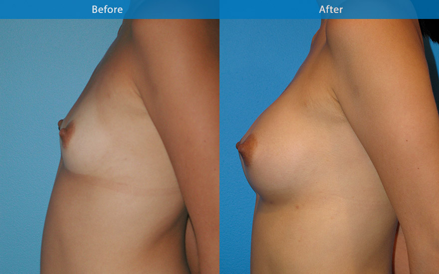 <h3>Case 6</h3><p><strong>Patient details:</strong></p><p>26 female,very athletic, enjoying running marathon. Like to have a conservative breast enhancement so that she can continue her current active athletic lifestyle. "Just want to fit into my clothing better, without having to have lots of room in my push-up bra"</p><p><strong>Surgical Plan</strong></p><p>Pre-surgical assessment revealed minor amount of breast tissue that has reasonable breast form. A moderate profile 250 gm round implant placed strategically to create a modest B cup as requested. The enhanced breast harmonised with her existing petite body frame as well as allowing her to continue her athletic lifestyle.</p>