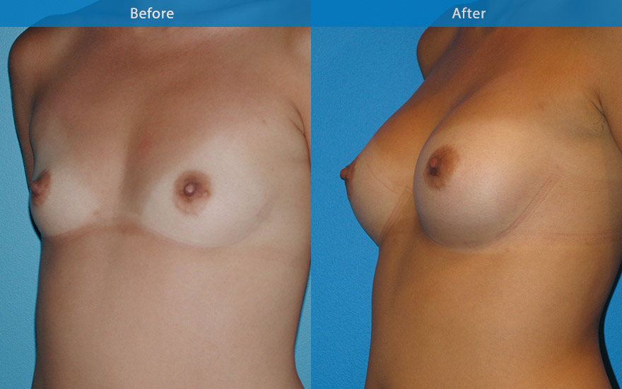 <h3>Case 6</h3><p><strong>Patient details:</strong></p><p>26 female,very athletic, enjoying running marathon. Like to have a conservative breast enhancement so that she can continue her current active athletic lifestyle. "Just want to fit into my clothing better, without having to have lots of room in my push-up bra"</p><p><strong>Surgical Plan</strong></p><p>Pre-surgical assessment revealed minor amount of breast tissue that has reasonable breast form. A moderate profile 250 gm round implant placed strategically to create a modest B cup as requested. The enhanced breast harmonised with her existing petite body frame as well as allowing her to continue her athletic lifestyle.</p>