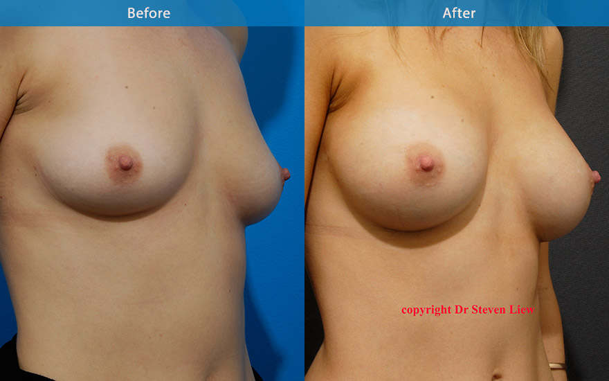 <h3>Case 7</h3><p>29 F, like the shape of her breasts, just like them fuller.</p><p>She has a long and lean body shape. It is important that any breast implants used, should maintain that beautiful lean body appearance. A small and proportionate enlargement from B to C cup with moderate profile round implants, creating a soft and natural looking breasts. The new breasts further enhanced her lean and long petite body frame.</p>