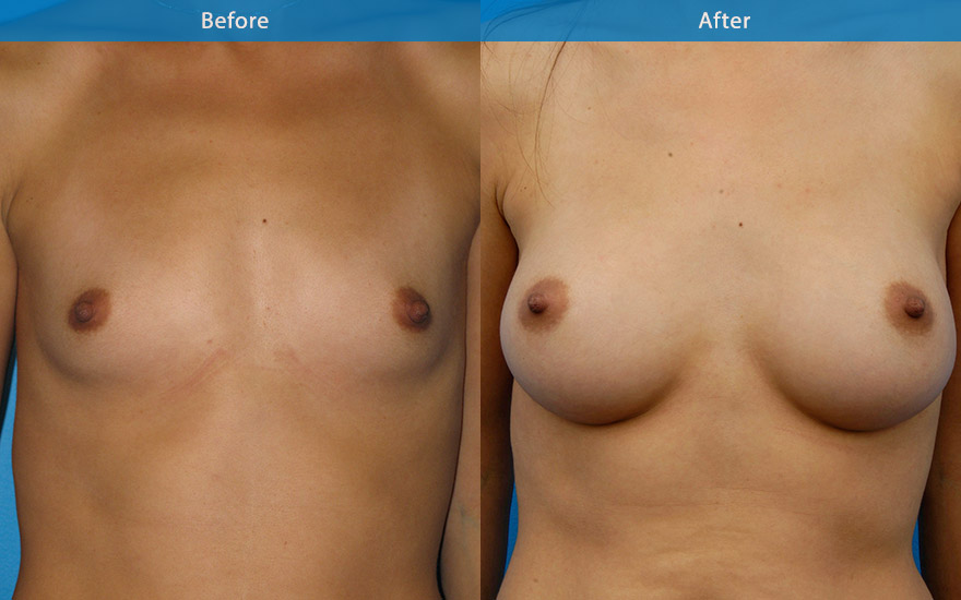 <h3>Case 8</h3><p>A small and proportionate enlargement from AA to B cup with moderate profile tear drop implant on a petite 48 kg patient.</p>