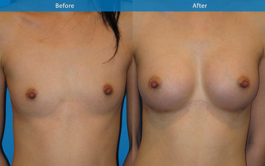 <h3>Case 9</h3><p><strong>Patient details:</strong></p><p>27 female requested a moderate breast enlargement that look as natural as possible. "I am doing it for myself and I just want to fit into most clothing and look nice"</p><p><strong>Surgical Plan</strong></p><p>This lady has virtually no breast tissue apart from skin and some muscle covering her rib cage. As a result, her breast and body exhibits lack of female form. Breast enhancement in this case involved the use of a 280gm tall tear-drop implant to recreate the breast shape. and to match her long chest. The end result is a full B cup as requested. The front and profile view showed an aesthetically pleasing and natural breast form. The new breasts not only camouflage the ribcage but also harmonise and create the beautiful hour-glass female body form.</p>