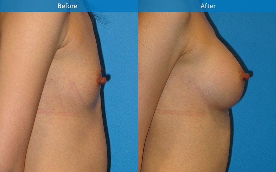 <h3>Case 9</h3><p><strong>Patient details:</strong></p><p>27 female requested a moderate breast enlargement that look as natural as possible. "I am doing it for myself and I just want to fit into most clothing and look nice"</p><p><strong>Surgical Plan</strong></p><p>This lady has virtually no breast tissue apart from skin and some muscle covering her rib cage. As a result, her breast and body exhibits lack of female form. Breast enhancement in this case involved the use of a 280gm tall tear-drop implant to recreate the breast shape. and to match her long chest. The end result is a full B cup as requested. The front and profile view showed an aesthetically pleasing and natural breast form. The new breasts not only camouflage the ribcage but also harmonise and create the beautiful hour-glass female body form.</p>